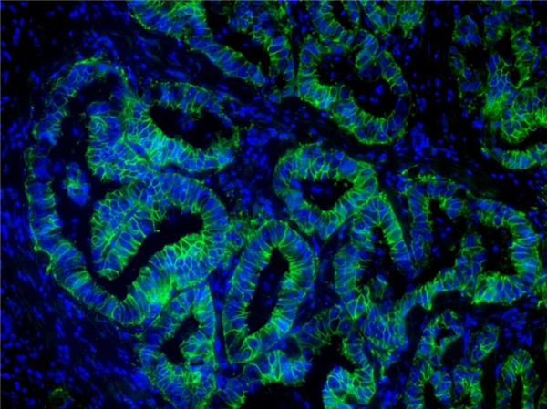 用泛角蛋白小鼠單克隆抗體標(biāo)記石蠟包埋的人肺癌的免疫熒光圖像