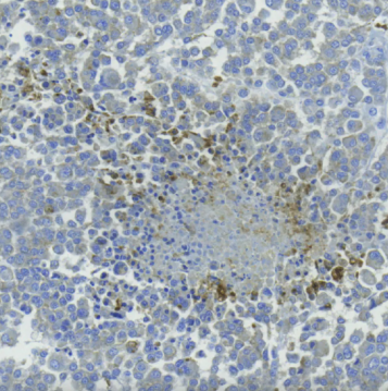 人乳腺腫瘤中辛納巴林酸的IHC檢測(cè)