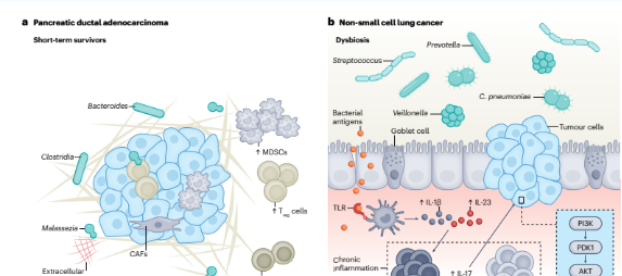 胰腺和肺部細菌相關(guān)的腫瘤發(fā)生